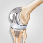 Joint Replacement in Ahmedabad