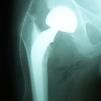 Arthroscopy Surgeon in Ahmedabad|Joint Replacement