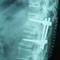 Best Orthopedic Surgeon In Satellite|Spine Treatment