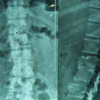 Sports Injuries Doctor in Ahmedabad|Spine Best doctor in satellite