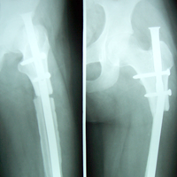 Orthopedic Oncology Doctor In Ahmedabad